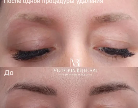 Удаление